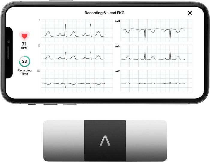 KardiaMobile 6L Evaluating the Best FDA-Cleared Portable EKG Device Performance